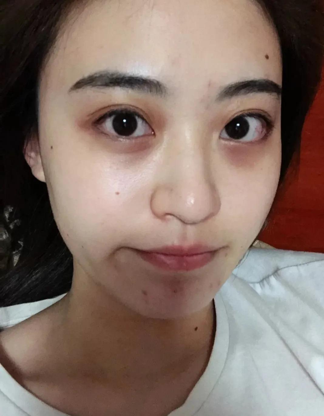 3种类型的黑眼圈怎么改善,混合型黑眼圈是身体出现什么问题