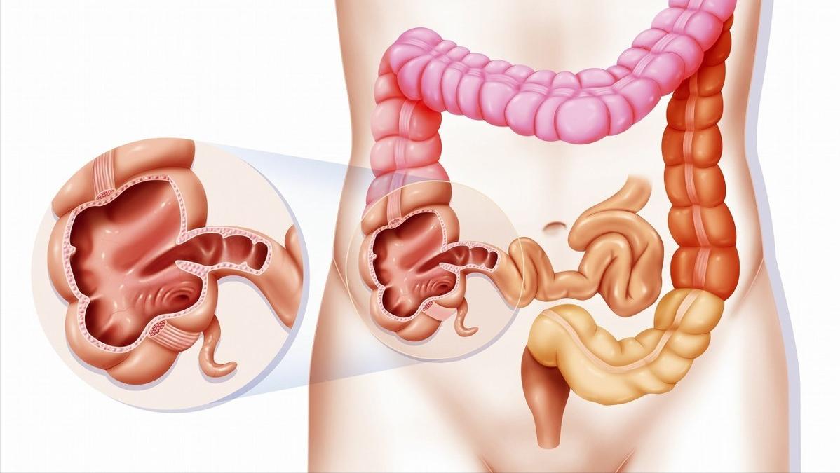 小小阑尾炎,小的阑尾有什么影响