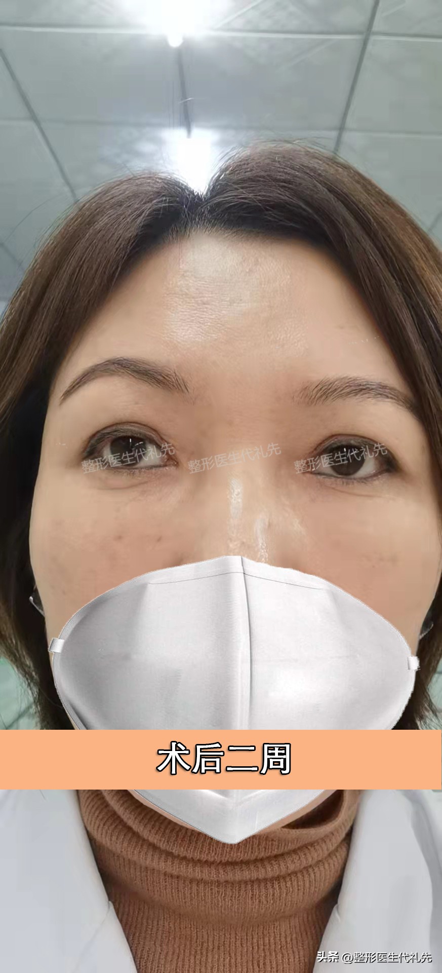 眼窝凹陷填充脂肪不成活怎么办,眼窝填充脂肪肿胀期眼睛睁不开