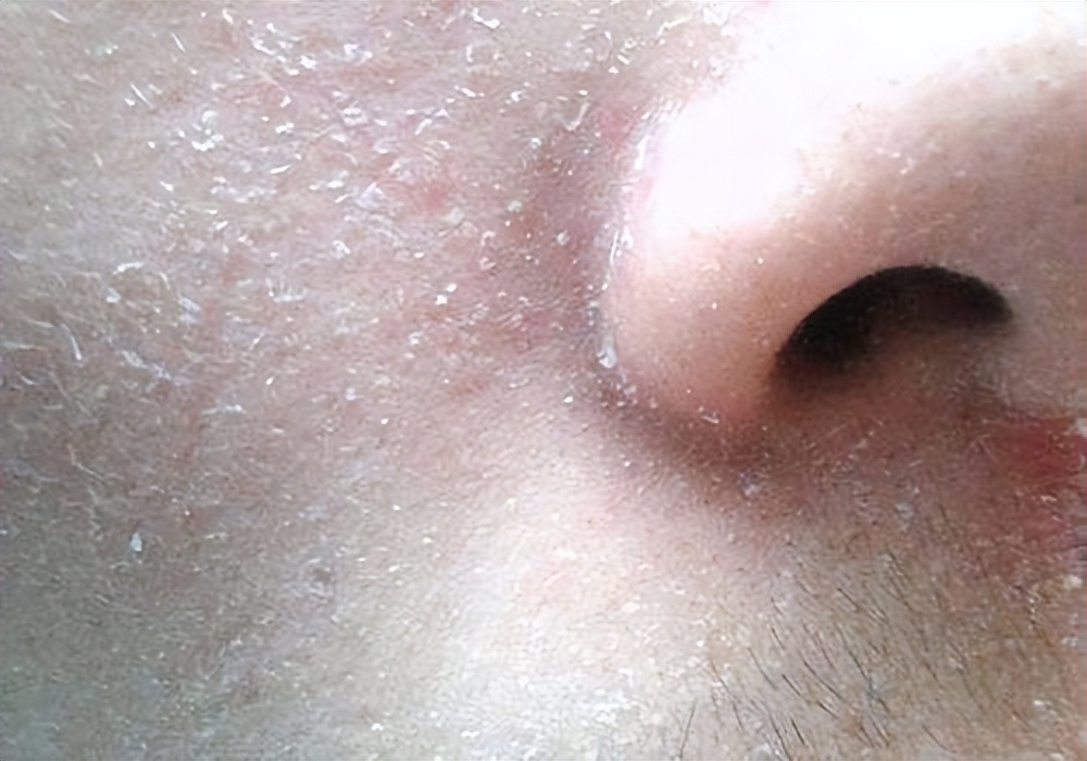 脸上起皮了是怎么回事,脸上起皮是什么原因怎么办