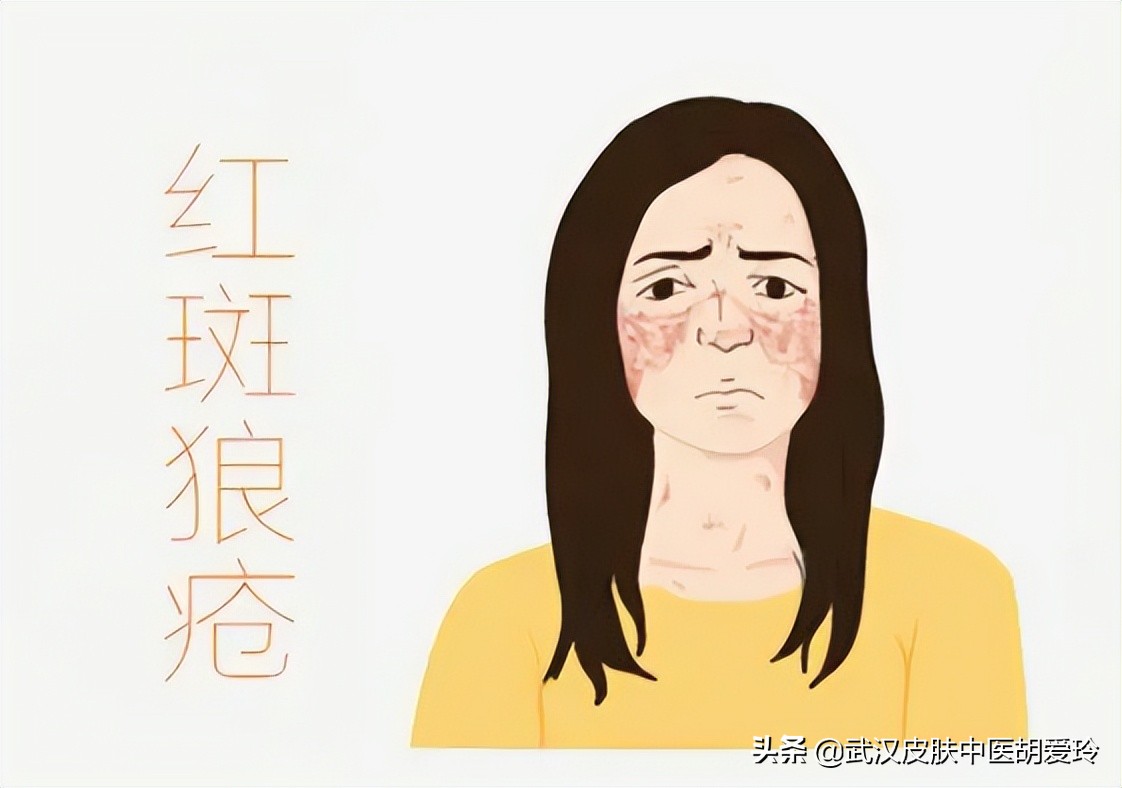 脸颊红肿是什么原因引起的,脸颊红是什么原因