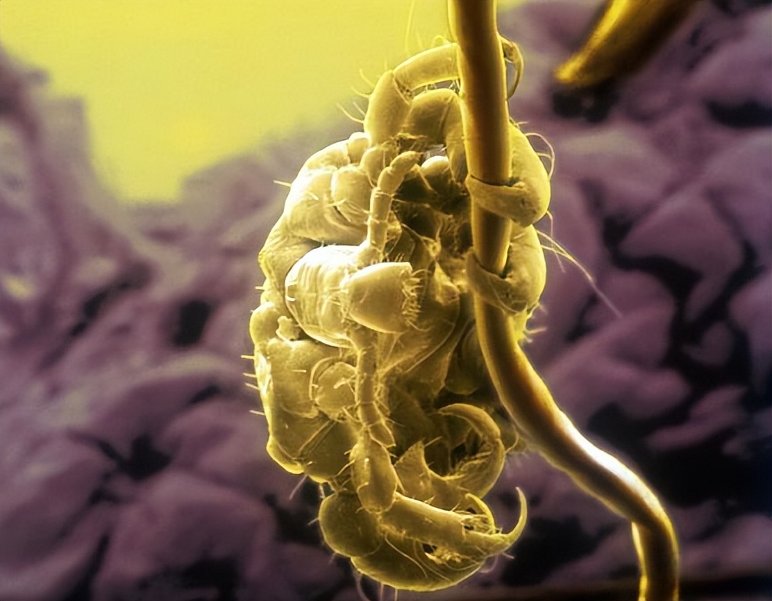 女子身上长虫医生拿镊子治疗,女子体内有蜱虫被医生拿镊子拔出