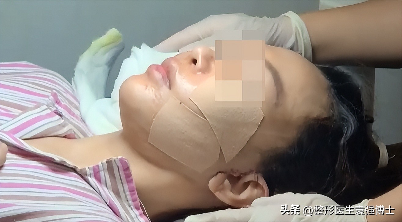 大拉皮术后一个脸大一个脸小,大拉皮后为什么一面脸大一面脸小