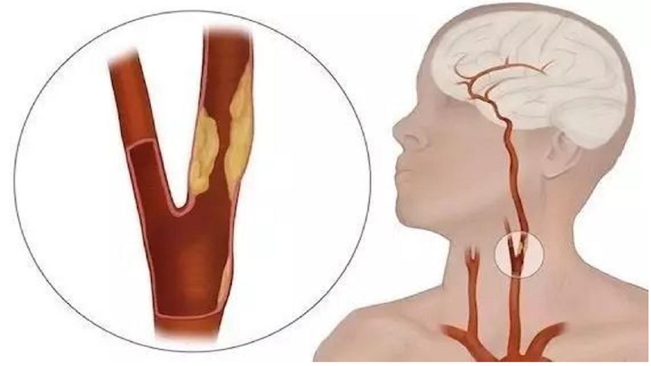 腿变细是预示身体什么病,腿型对腿粗细的影响