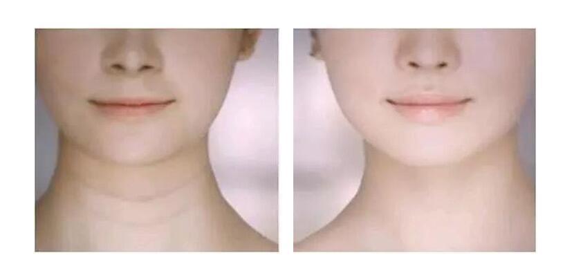 颈纹很显老手把手教你小妙招,颈纹深怎么减淡