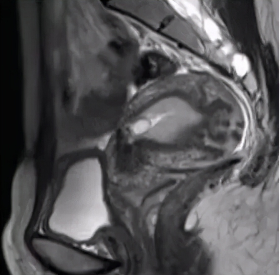 剖宫产术后瘢痕妊娠彩超诊断依据,剖腹产后子宫筛查可以不做吗