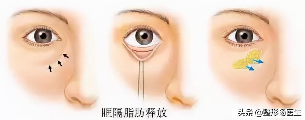 眼袋手术后真的显年轻吗,割眼袋能年轻几岁