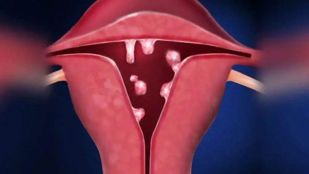 出血不止有血块是什么原因,排卵期出血跟子宫内膜息肉有关吗