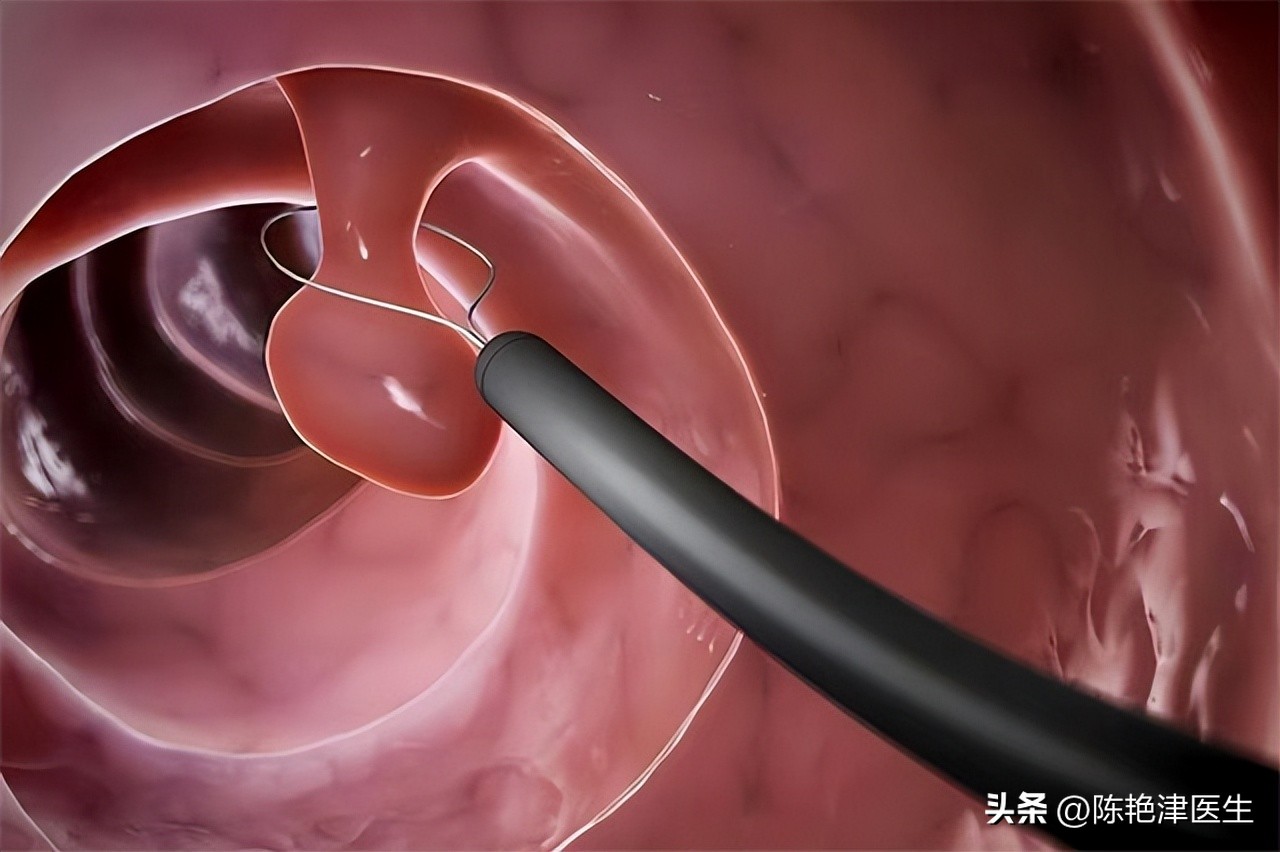 大肠癌治疗后肠息肉反复生长,息肉已经切除怎么还得大肠癌