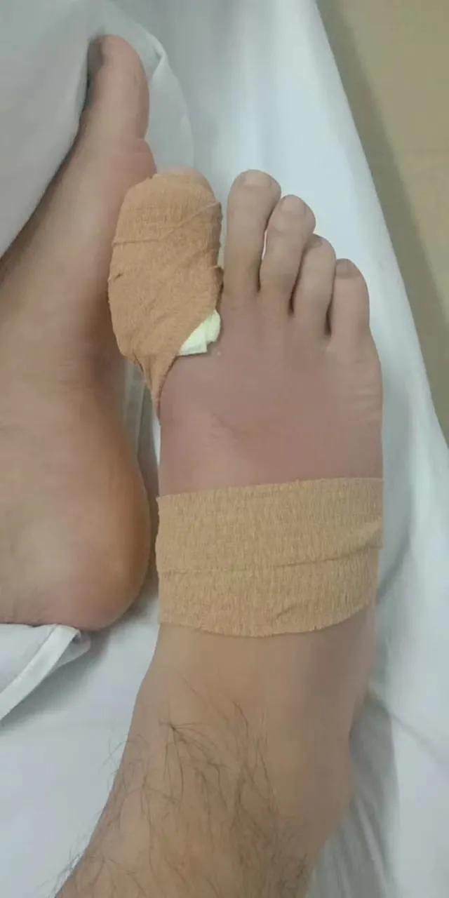 在医院做一个脓包手术大概多少钱,脓包治疗需要多少钱