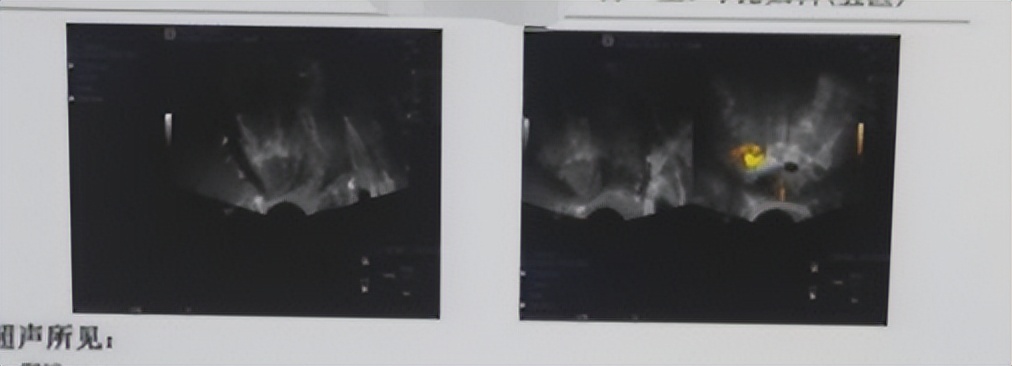 子宫腺肌症痛经厉害急诊怎么治疗,子宫腺肌症引起重度痛经