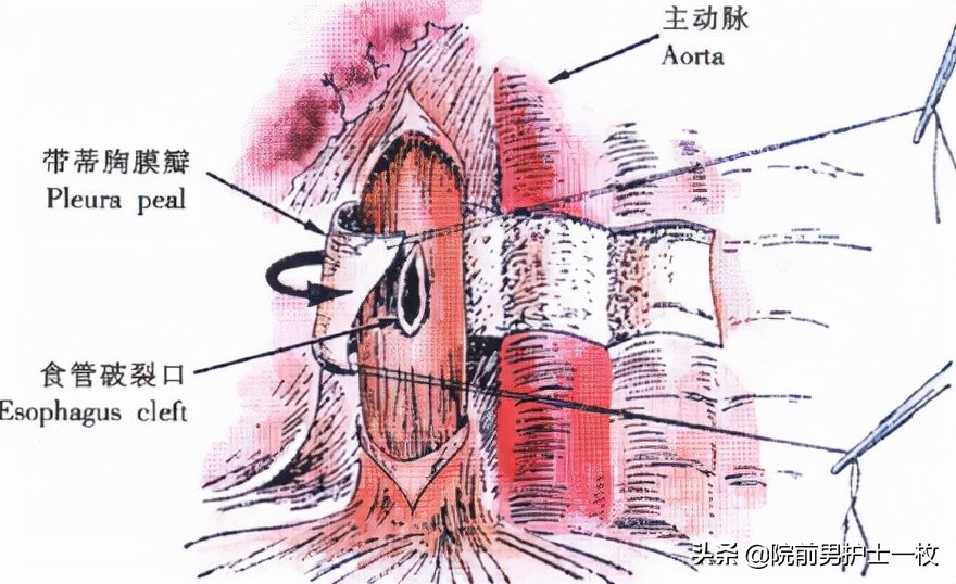 「急救」鱼刺卡喉如何处置