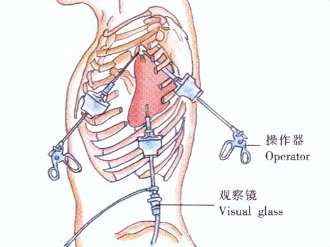 胸腔镜下胸膜冷冻活检，在胸腔积液诊断中，有价值和安全性么