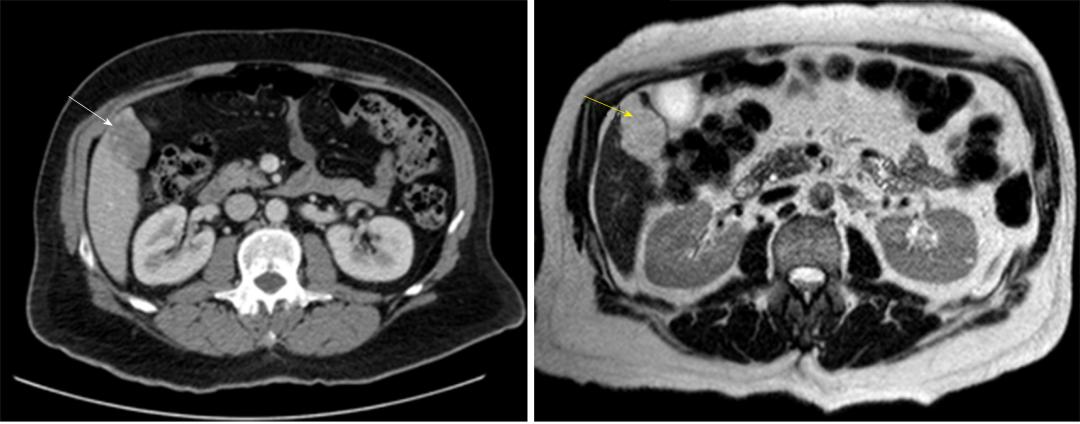 肝脏良性血管瘤,肝脏实性占位考虑肝血管瘤可能