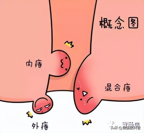 得了痔疮真烦恼四处求医没治好,治愈痔疮有奇招方法简单一看就会