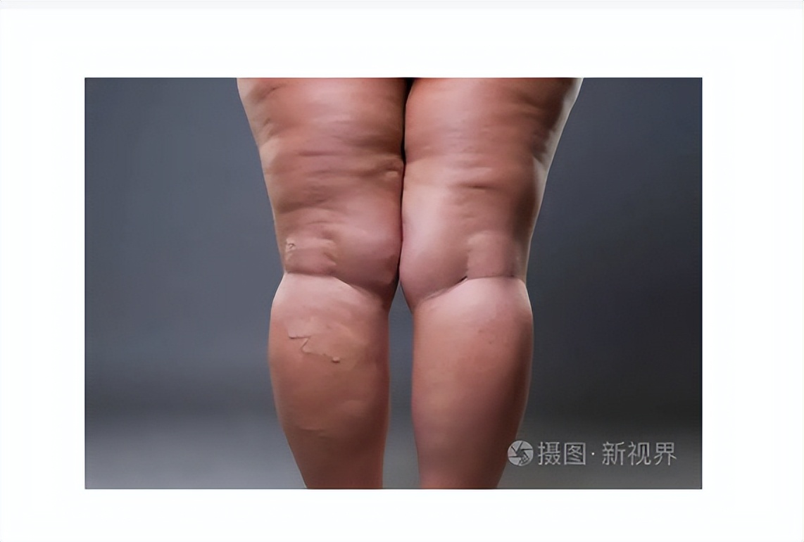 北京医院血管外科李鹏：下肢静脉曲张，如何治疗？