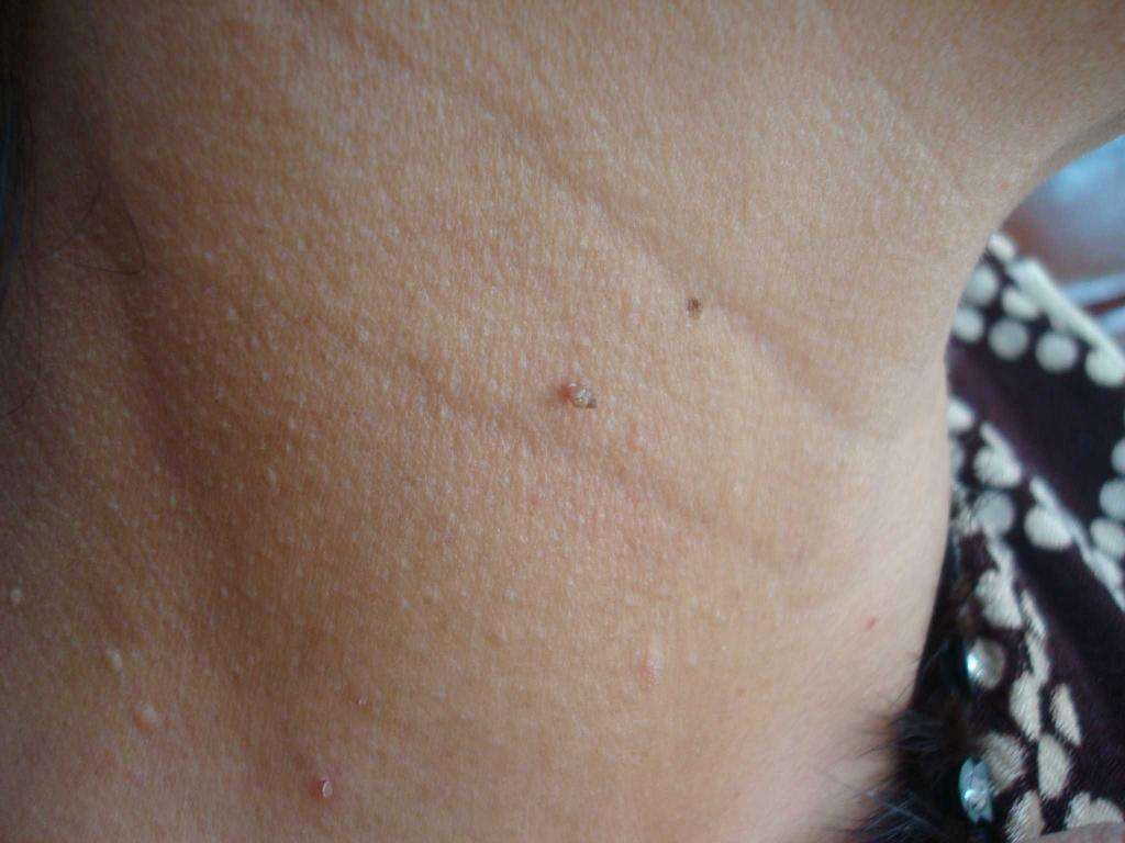 别忽视脖子上的“小颗粒”,注意,这是丝状疣!一招教你变光滑