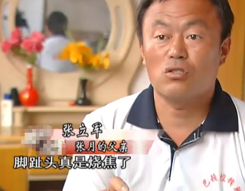 20岁小伙被重度烧伤七年后续,山东男子下肢被烧伤