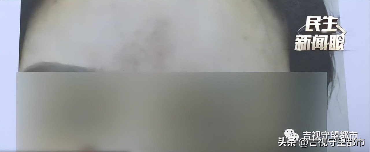 做完填充1年水肿,面部取出填充物手术