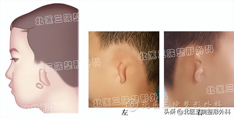 耳廓再造的三个方法,双侧无优势会影响移植吗