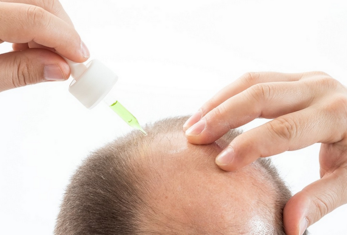 怎么脱发最有效果,怎么样脱发才算严重