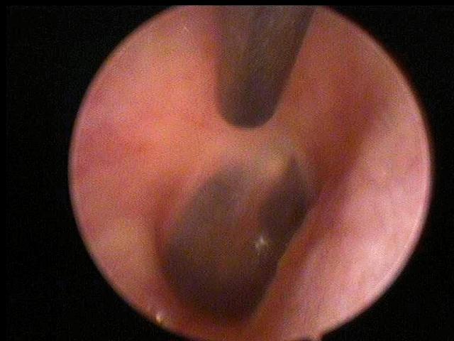 耳朵里面发霉长毛要清除吗,耳朵里长毛发霉了