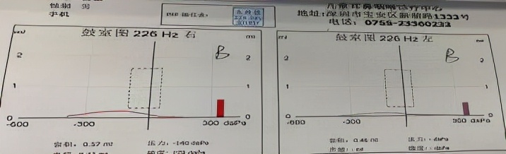 分泌性中耳炎可以吃耳聋通窍丸吗,儿童中耳炎鼓膜内陷耳鸣