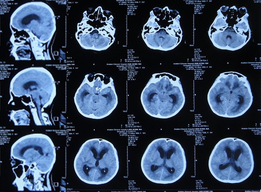 结核脑炎型脑积水怎么治,结核性脑膜炎2期很严重吗