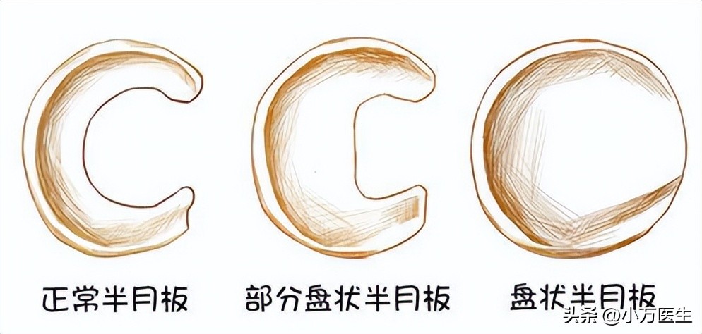 半月板后角撕裂微创手术,半月板撕裂分型