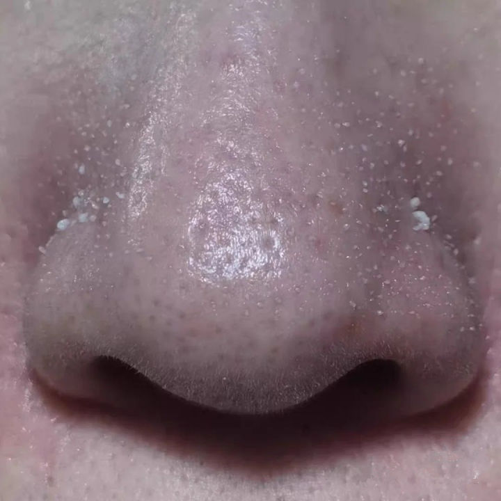 美容院清洁黑头会让毛孔变大吗,黑头拔了毛孔变大会自己愈合吗