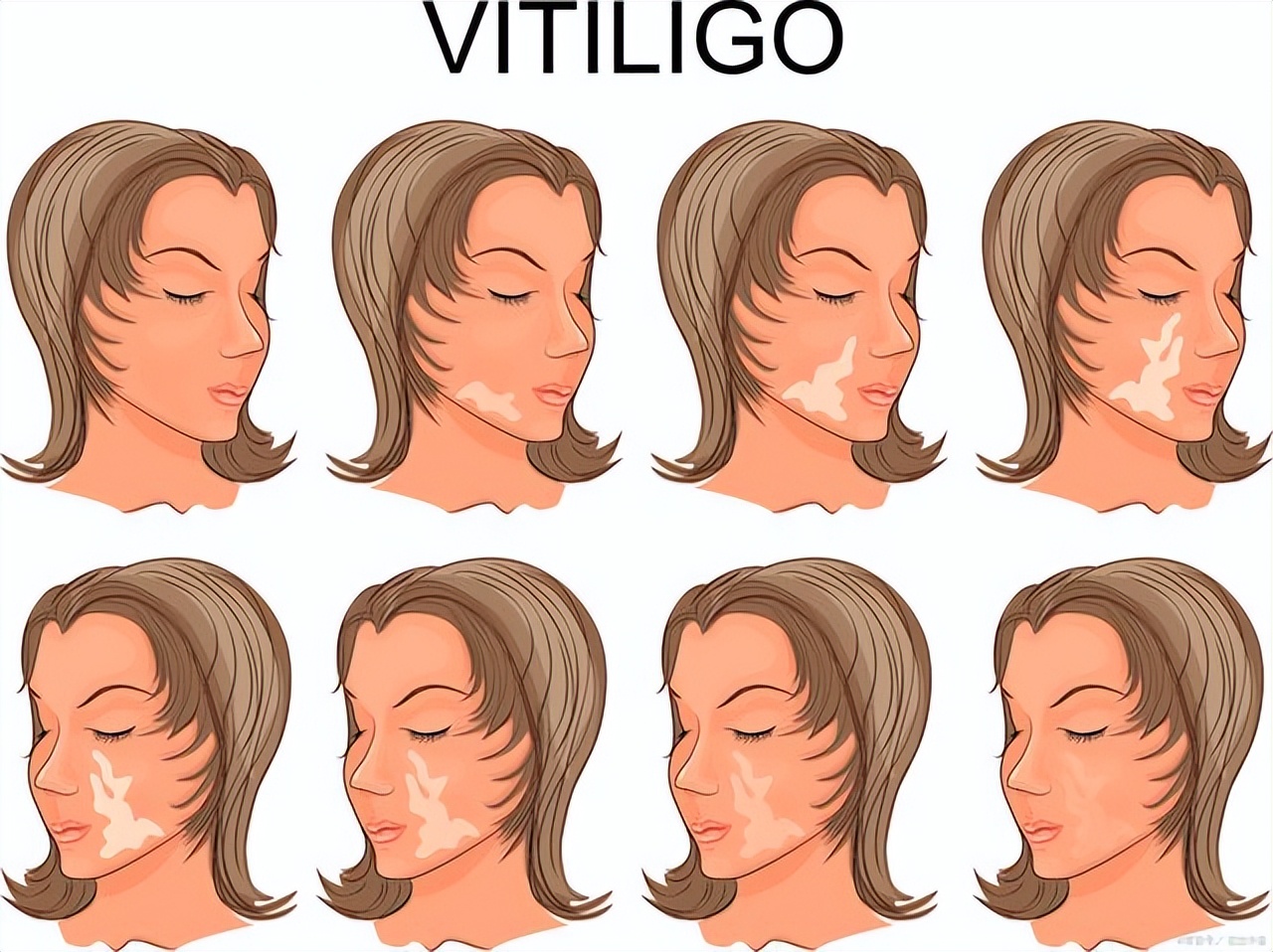 皮肤色素减退和白癜风有什么区别,白癜风是不是色素性皮肤病