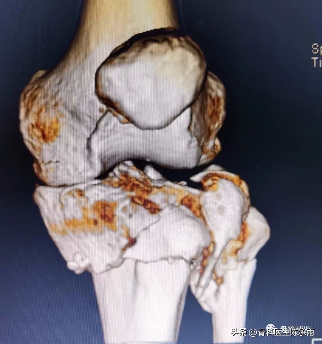 膝关节胫骨平台骨折,最近胫骨平台骨折视频