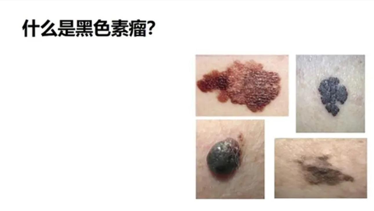 牛津大学：吃鸡或增加3种癌风险？老实说：4种食物确实要少吃