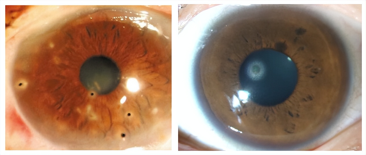 异物入眼能自愈吗,异物科普视频