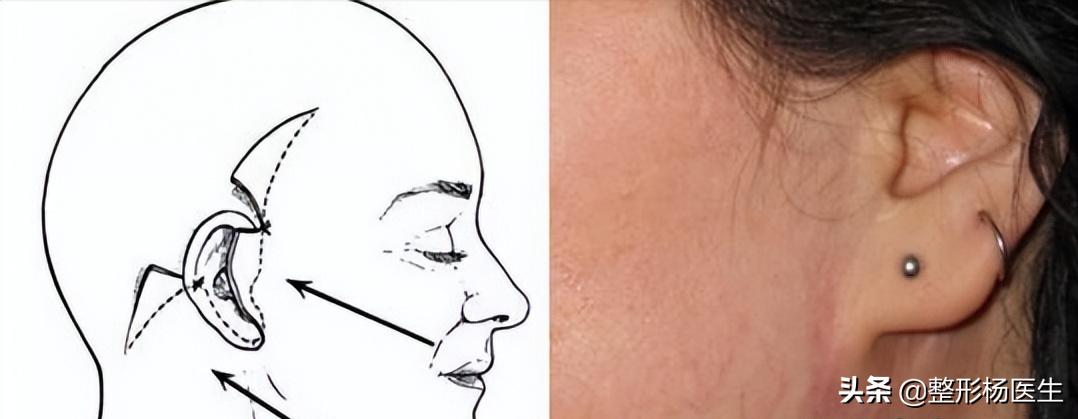 拉皮手术的危害真实案例,做拉皮手术副作用太可怕