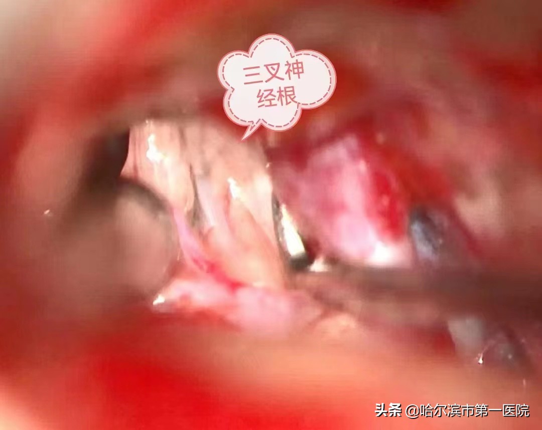 七旬大娘吃饭都“费劲”原是三叉神经痛难“张口”哈尔滨市第一医院神经二外科微血管减压术解除患者十年顽疾