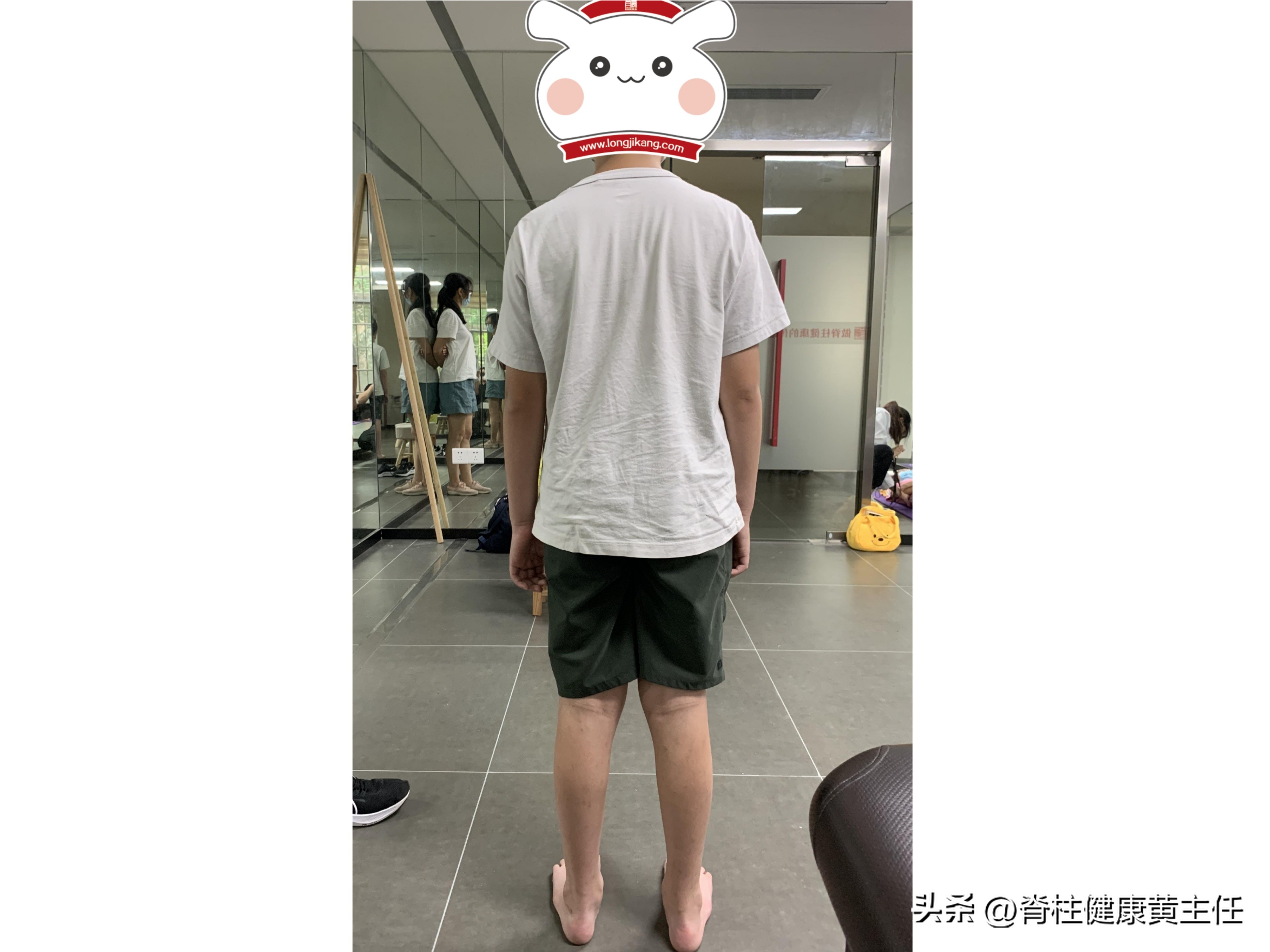 扁平足o型腿骨盆前倾高低肩,一只脚是扁平足怎么矫正