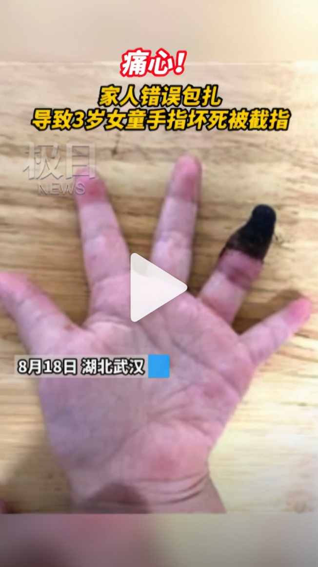 孩子磕碰怎么办,小孩子磕碰划伤擦什么药好