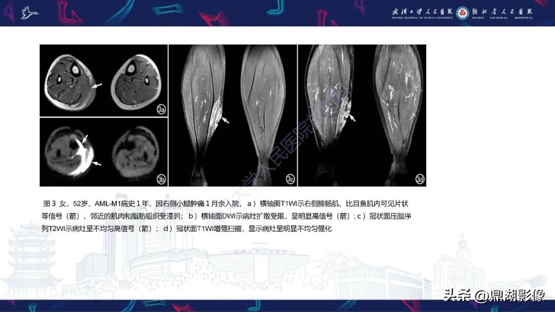 阴道肉瘤症状,阴道肉瘤的早期症状