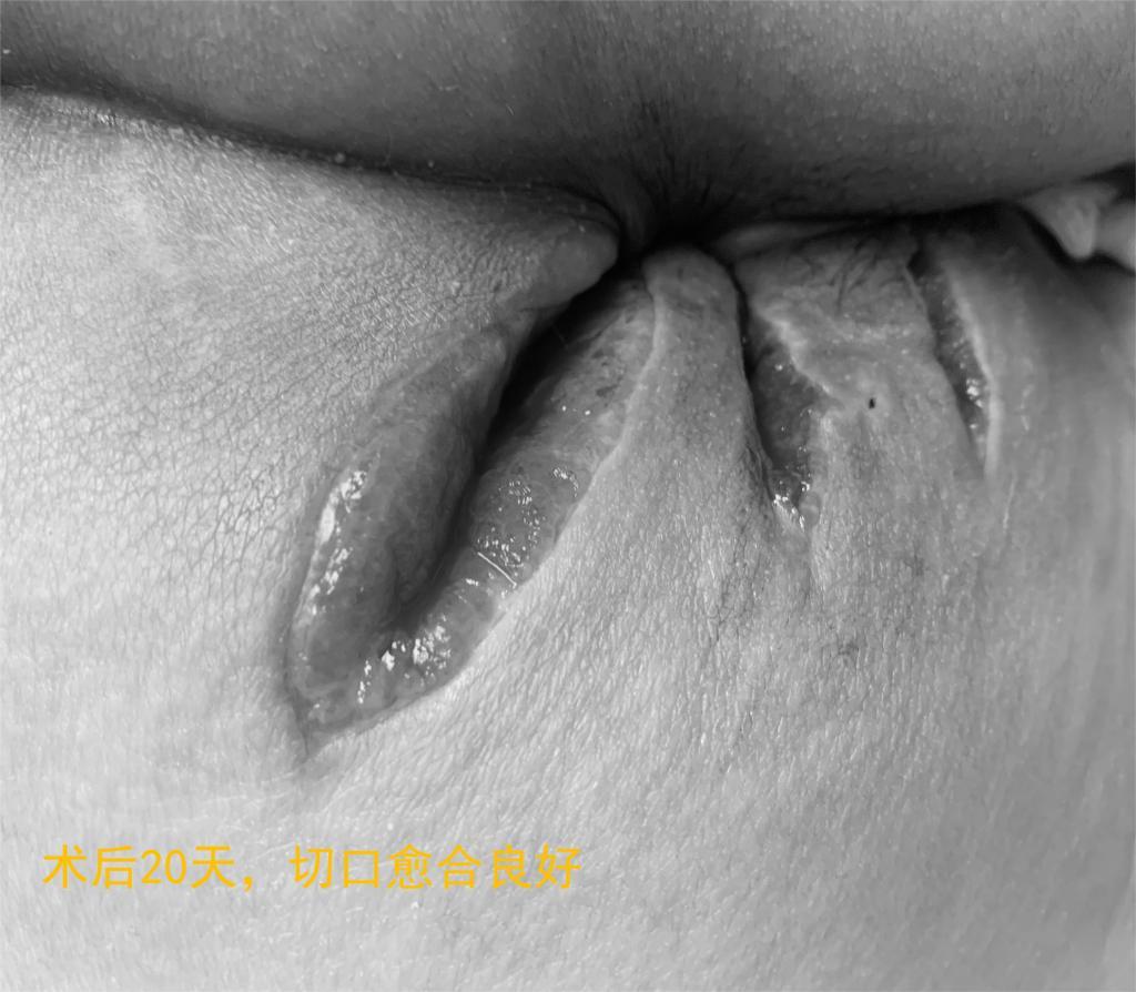 肛周脓肿被医生诊断痔疮,中医治疗肛门脓肿痔疮