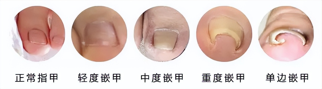 一走路脚趾甲疼,一走路脚趾疼是怎么回事