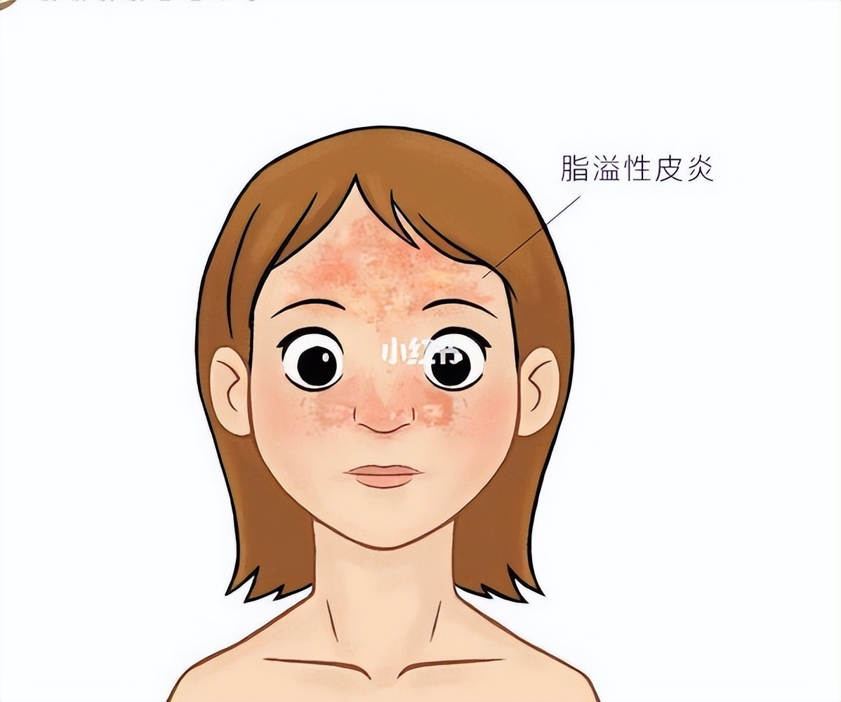 脂溢性皮炎吃什么维生素,头皮脂溢性皮炎用什么药