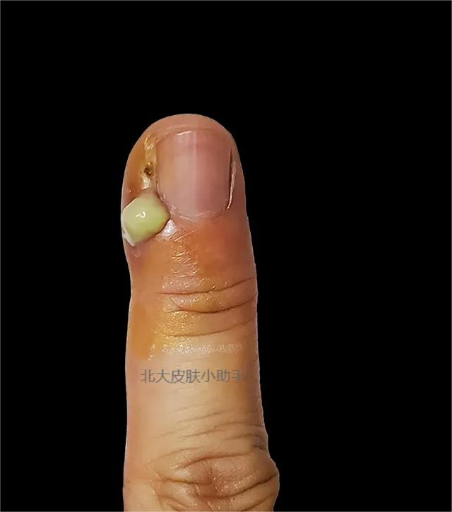 手贱喜欢抠指甲怎么办,撕掉手指甲盖死皮