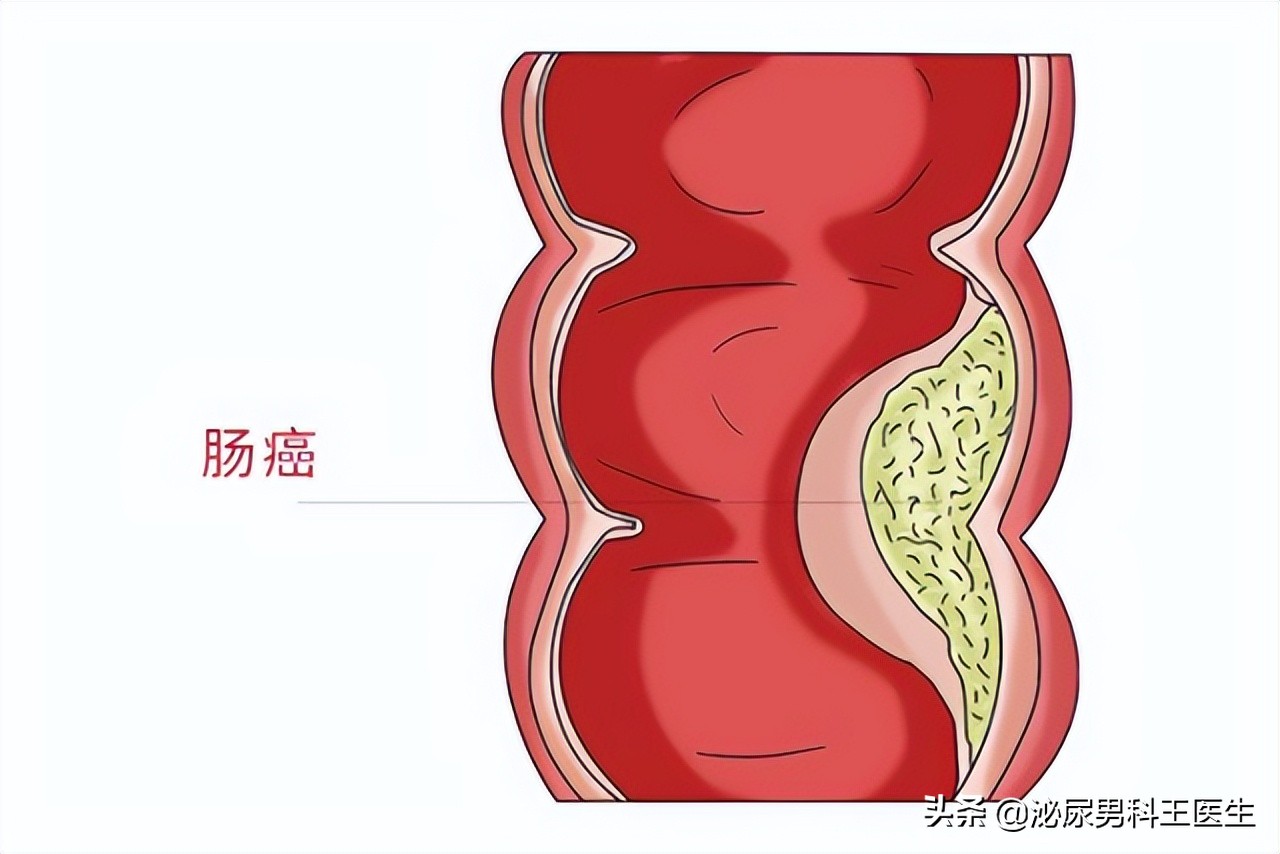 直肠癌早期身体发出3个救命信号,直肠癌症状是先下坠还是便血