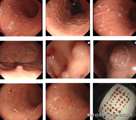 一位医生自己切息肉,50分钟能切除100多枚胃息肉吗