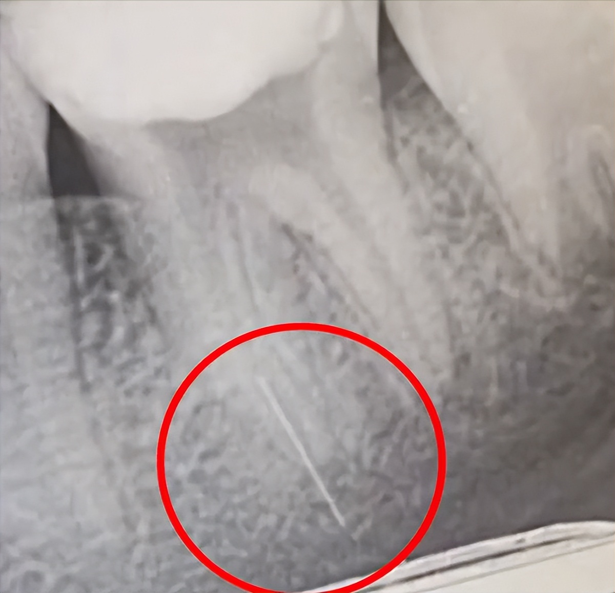 做根管治疗期间牙齿劈了,做根管治疗的牙断了一部分