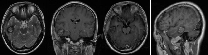 脑科手术难保秀发？医生从约1.3cm的骨孔实施手术