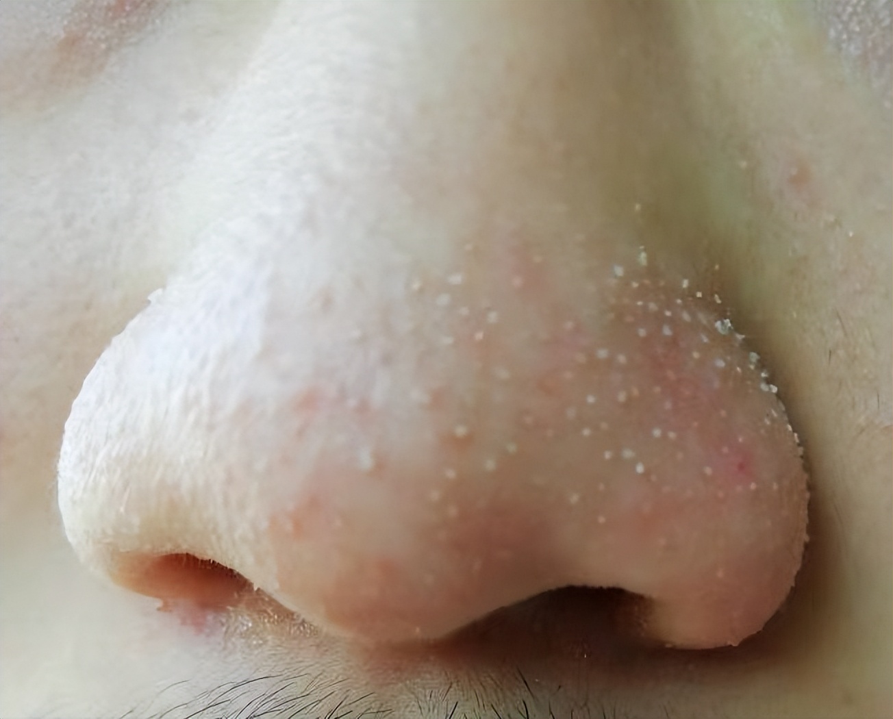 毛孔堵塞怎样才能疏通毛孔,身上毛孔堵塞不出汗怎么疏通毛孔