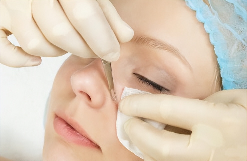 鼻子里挤出的白色细条是螨虫吗,鼻子上的螨虫怎么去除最快方法