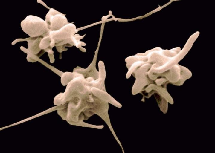 医生科普食管腺癌的发病原因,腺癌是什么原因引起的